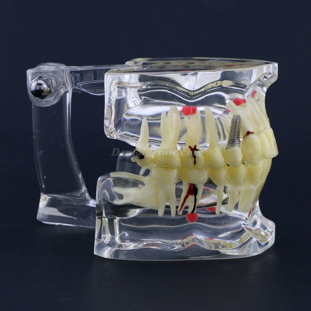 Neue Dental Teach-Studie Allgemeine Erwachsenenpathologie Typodont Z&auml;hne Modell # 4001